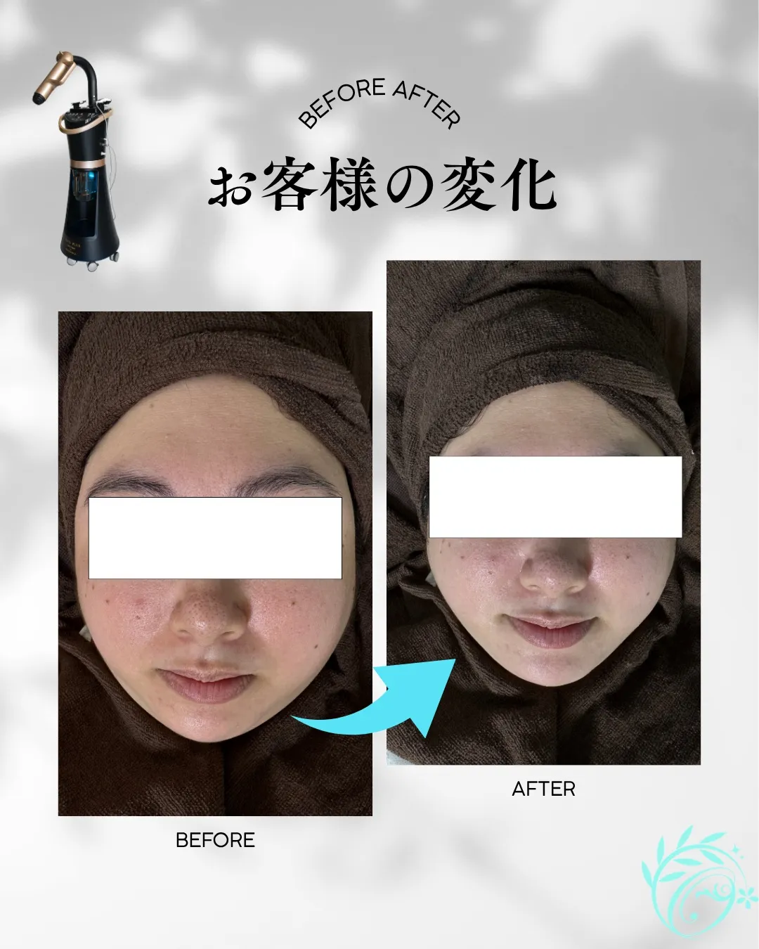 エイン毛穴洗浄でここまで変化【足立区エステ】
