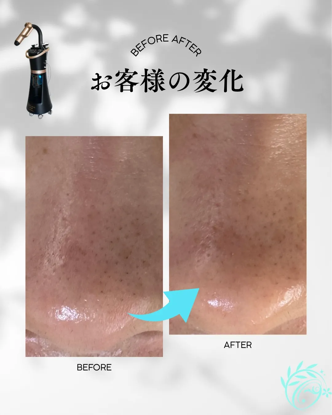 毛穴の黒ずみ・ザラつき、気になっていませんか?🫧【足立区エス...